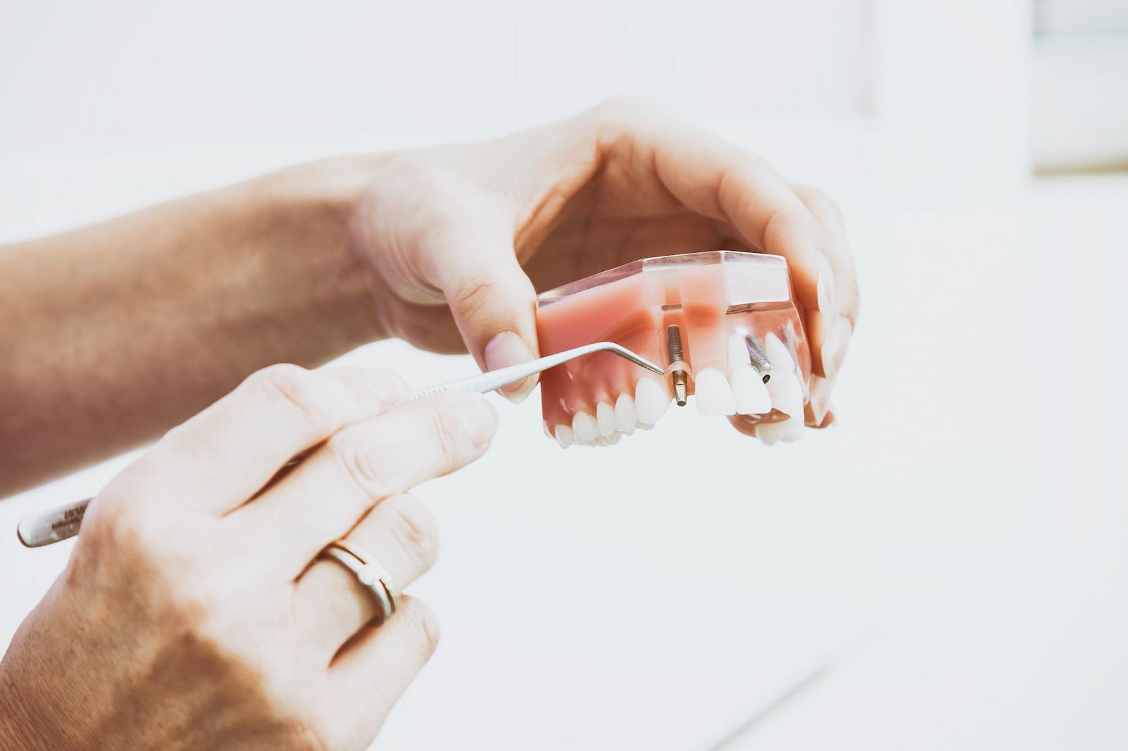 implantes dentales girona costa brava